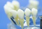 임플란트, 시술 후가 더 중요하다