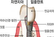)임플란트 건강보험 제대로 받기 위해 꼭 알아둬야 할 것
